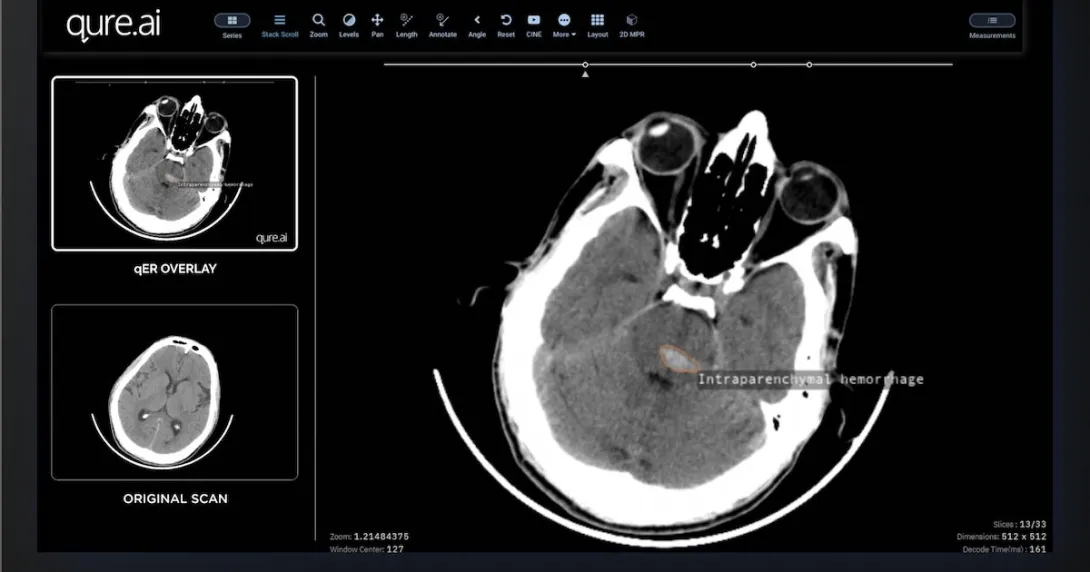 
   Interface of the Qure.ai qER software
