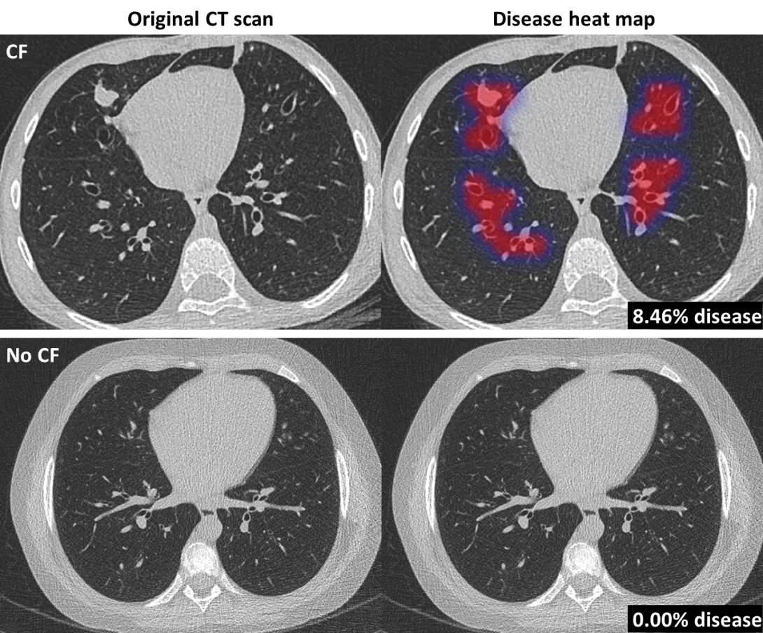 cystic fibrosis, Thirona